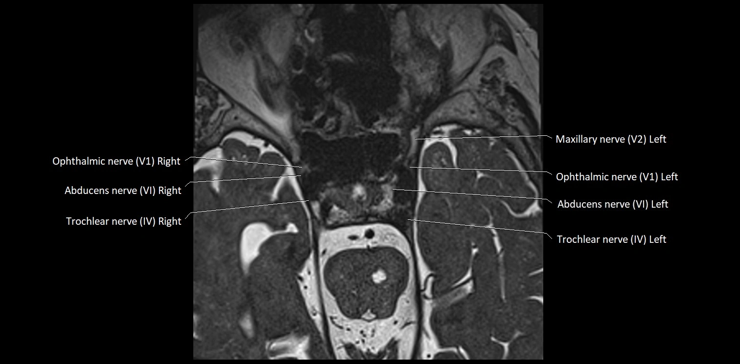Cranial nerve anatomy axial MRI 3T image 29.webp
